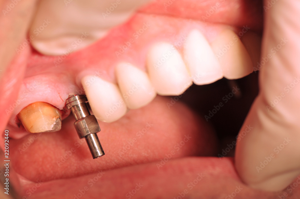 Close-up of patient's implantation of teeth applied mouth