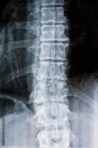 Röntgenbild einer Wirbelsäule © Gina Sanders