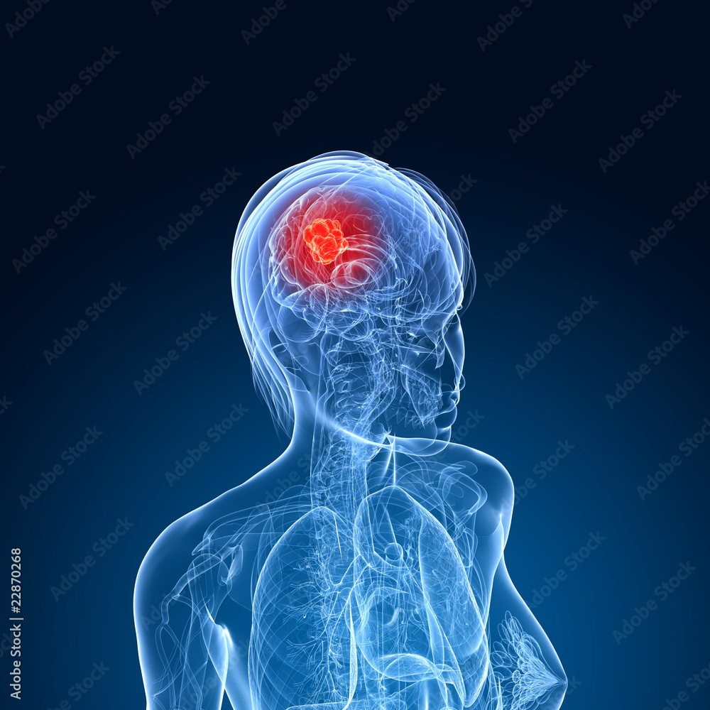 Gehirntumor Gehirntumor