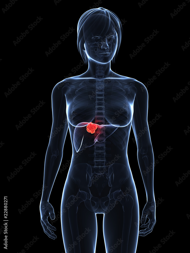 markierter Lebertumor markierter Lebertumor