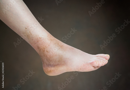 Fotografie ankle sprain