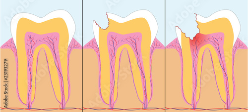 Three phase of caries, vector illustration