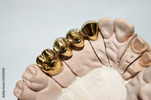 Zahnersatz Goldbrücke