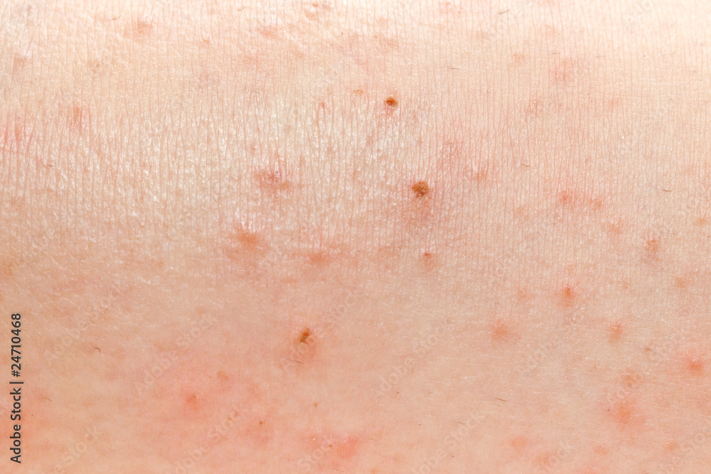 © Stéphane Bidouze - plants thorns wound in the flesh