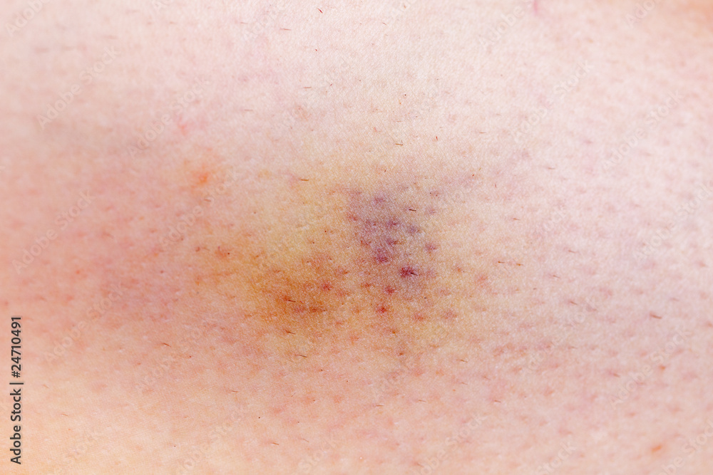 bruised woman skin