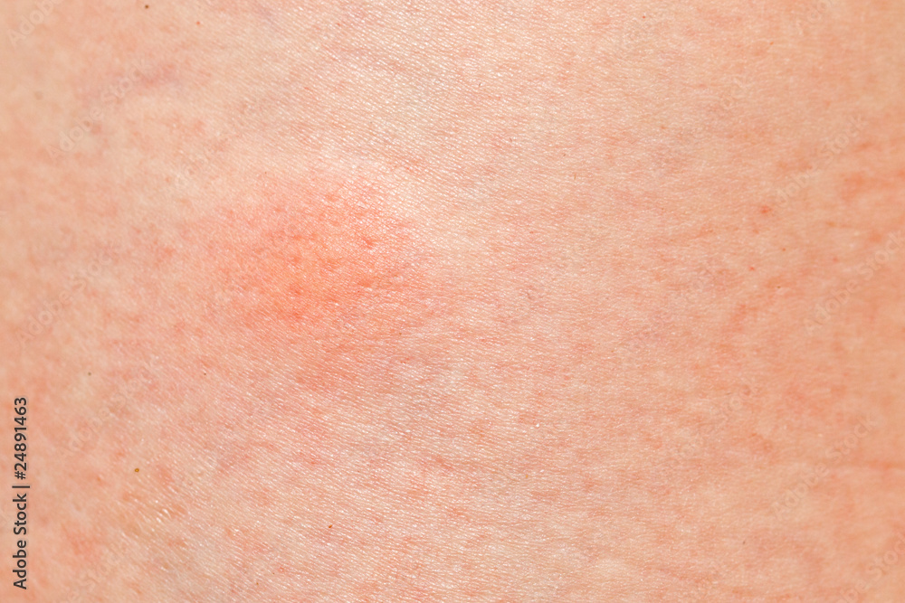 mosquito pimple on woman skin