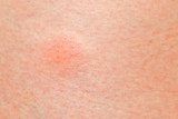 mosquito pimple on woman skin