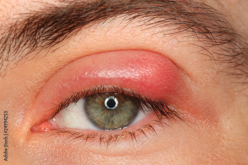 illness person eye with sty and pus looking into camera photo