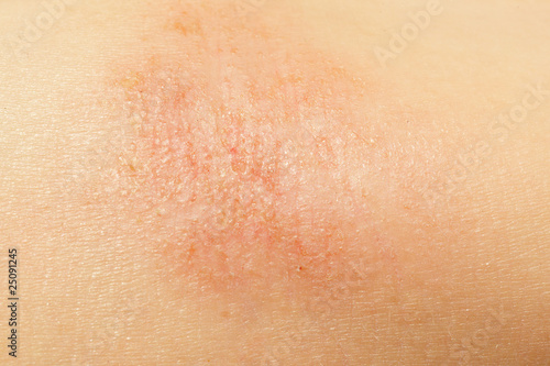 eczema on child skin