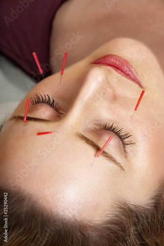 Acupuncture treatment to face