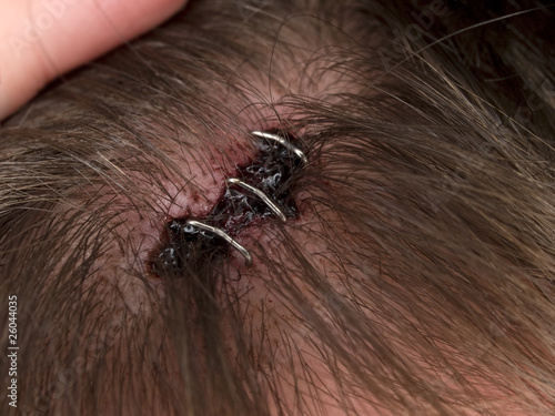 head wound - staples photo