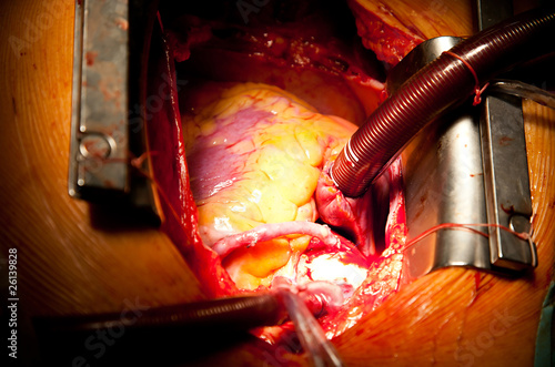 Obraz na plátně coronary artery bypass grafting