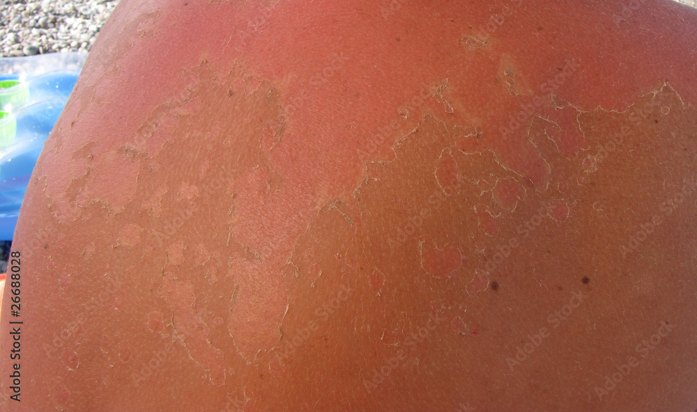 Fototapeta premium sunburn
