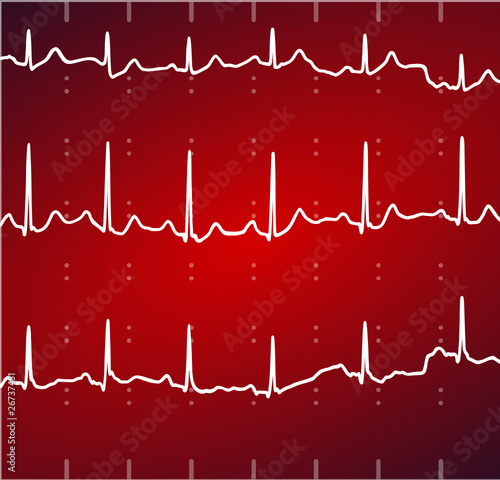 électrocardiogramme ecg