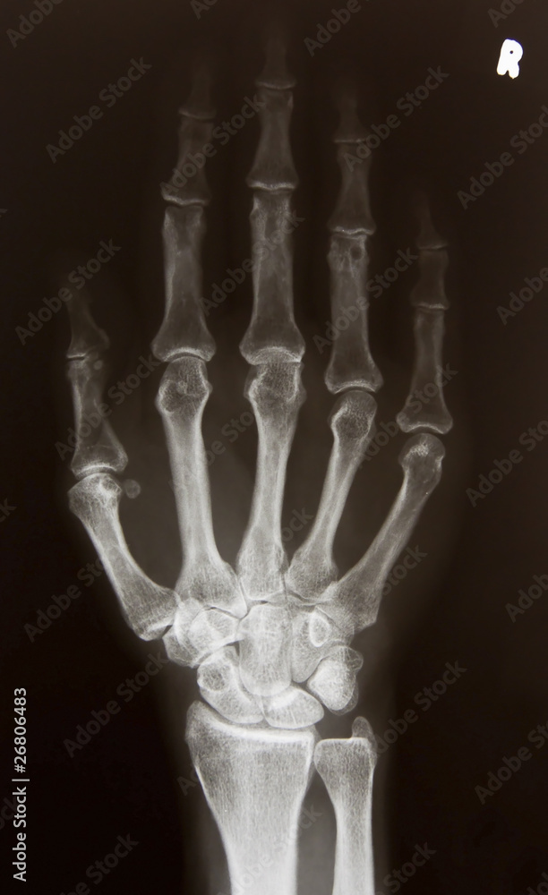 X-ray picture of right hand X-ray picture of right hand