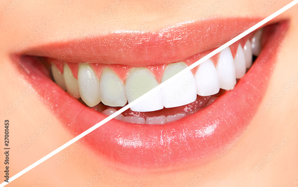 Fotografie Teeth whitening
