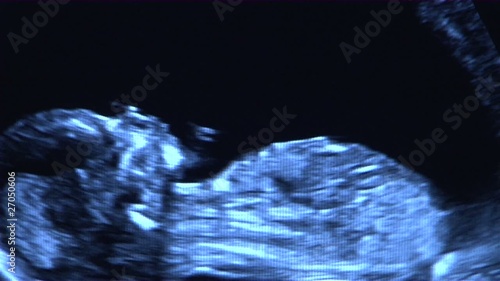 Ultraschallbild Kind