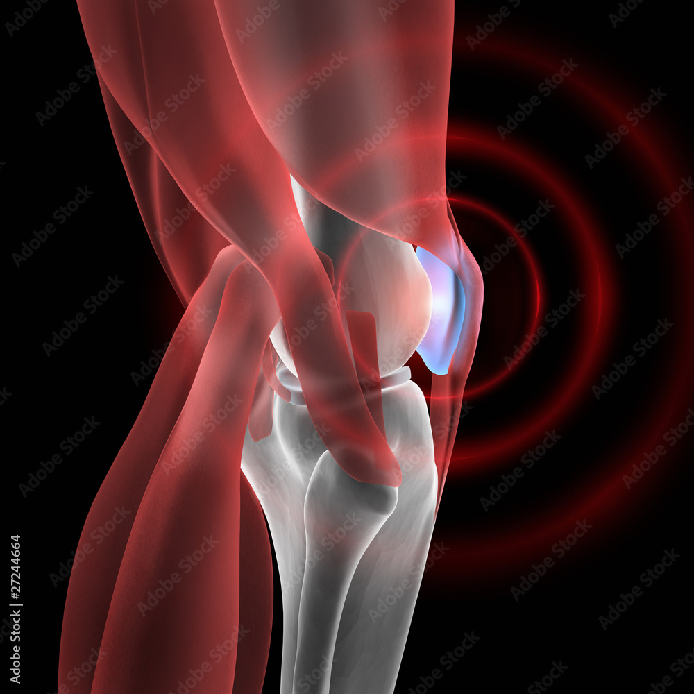 Meniskus Schmerz 2 StockIllustration Adobe Stock