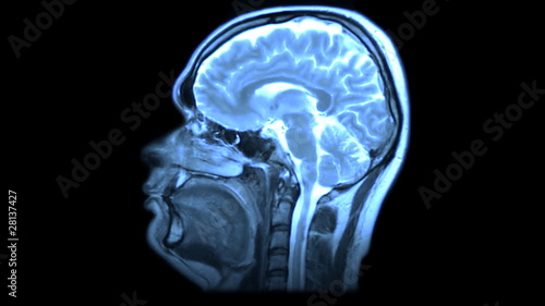 MRI brain scan