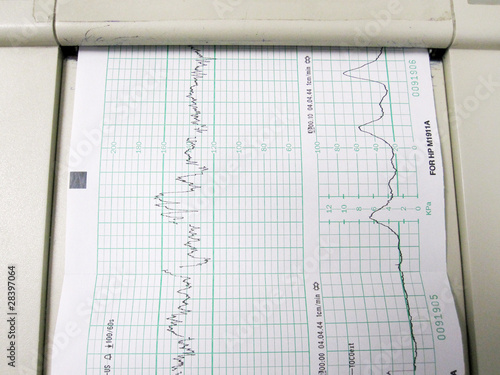 featus beat and contraction graph photo