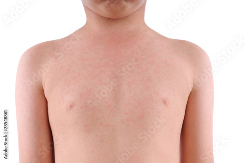 Close up image of a little boy’s body suffering urticaria.
