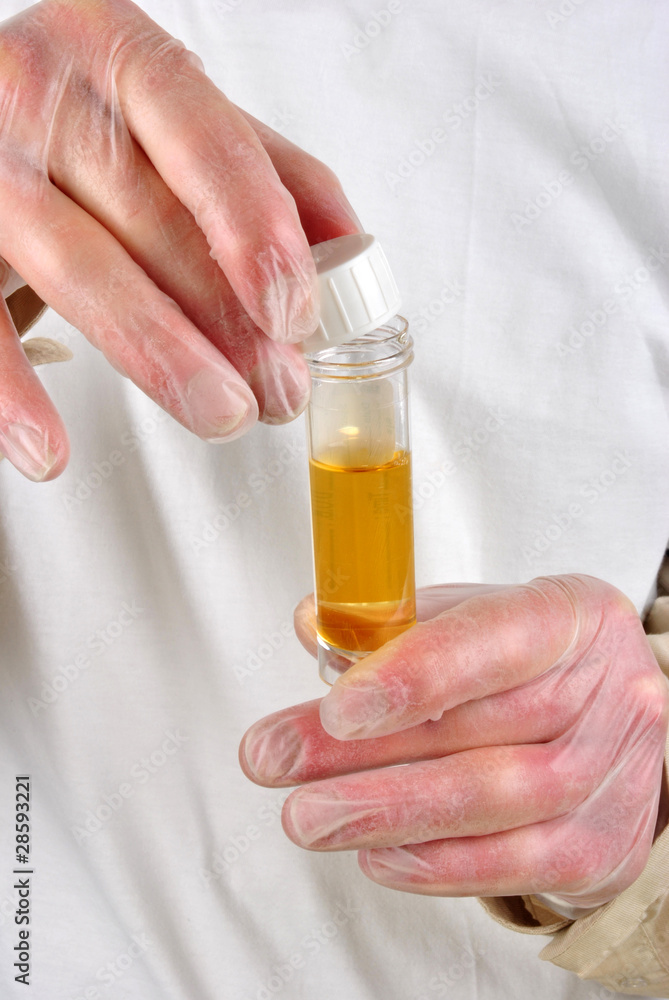 eine Urinprobe in einer Probenflasche eine Urinprobe in einer Probenflasche