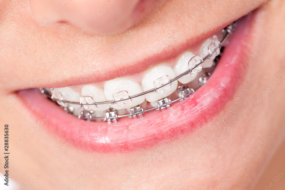 Obraz premium Mund mit Zahnspange und schönen Zähnen