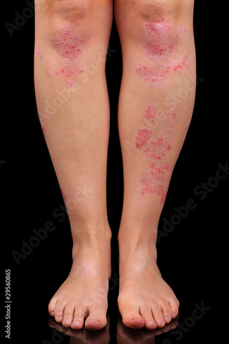 Psoriasis