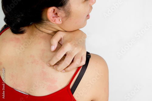 Fotografie Ethic young woman back with itchy skin