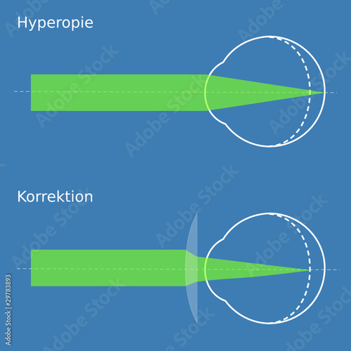 Schema Hyperopie mit Korrektion