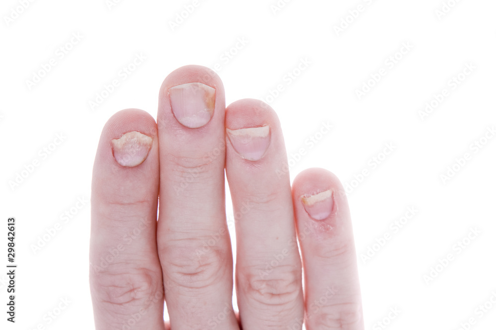 Psoriasis on Fingernails Isolated White Background Psoriasis on Fingernails Isolated White Background