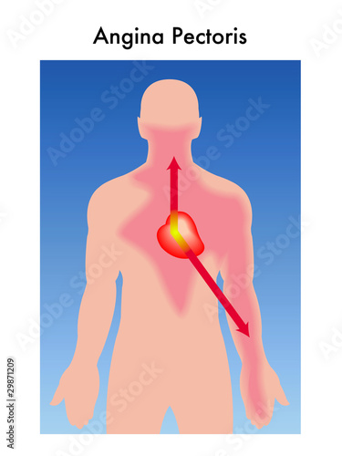 Angina Pectoris