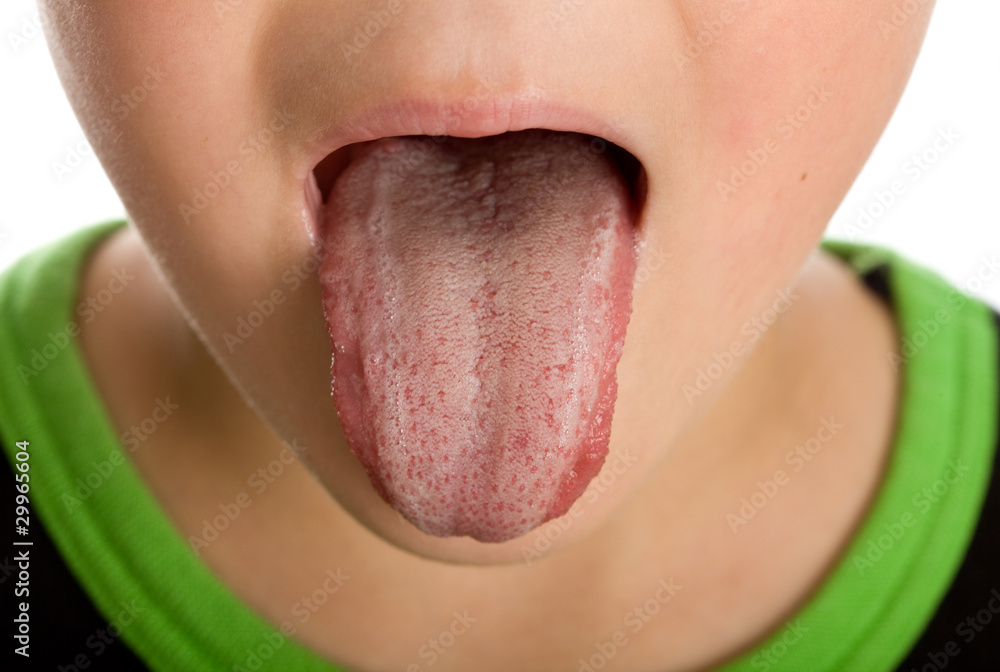 Fototapeta premium Unhealthy furred or coated tongue