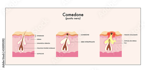 comedone