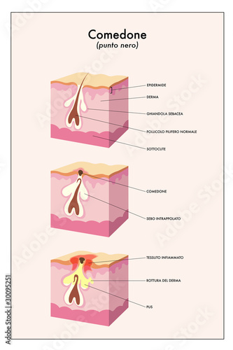 comedone photo