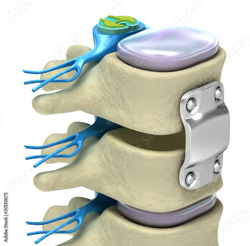 Spinal fixation system - titanium bracket isolated on white photo