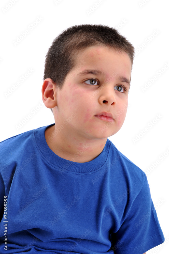 Little boy’s face suffering severe allergic reaction, urticaria. Little boy’s face suffering severe allergic reaction, urticaria.