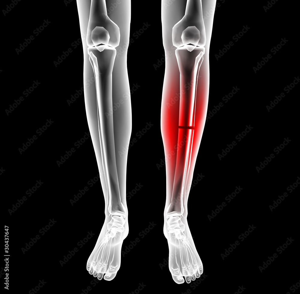 broken leg under the X-rays broken leg under the X-rays