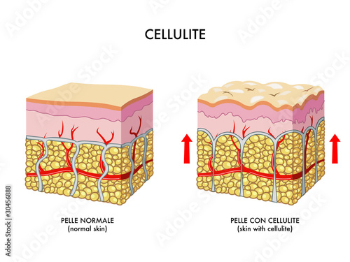 cellulite