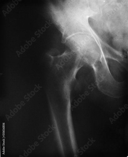 X-ray of the hip joint