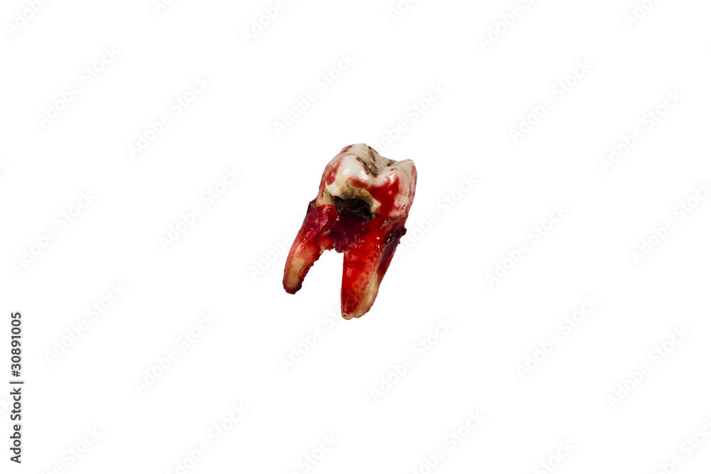 Decayed Molar