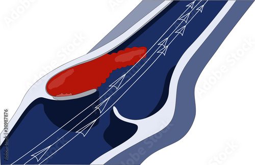 venous thrombosis