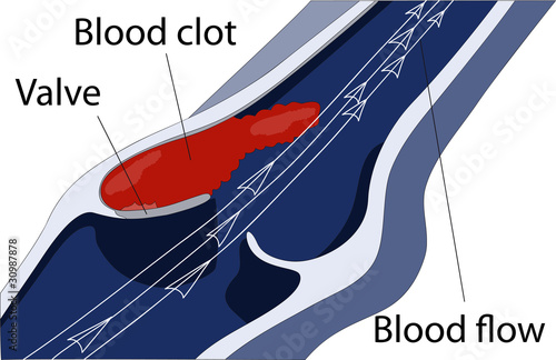 venous thrombosis1