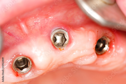 A macro shot of dental implants in the oral cavity