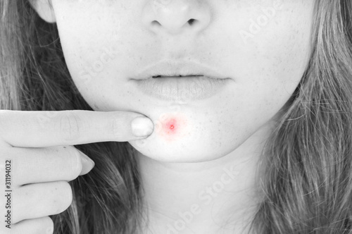 Photos Painful pimple