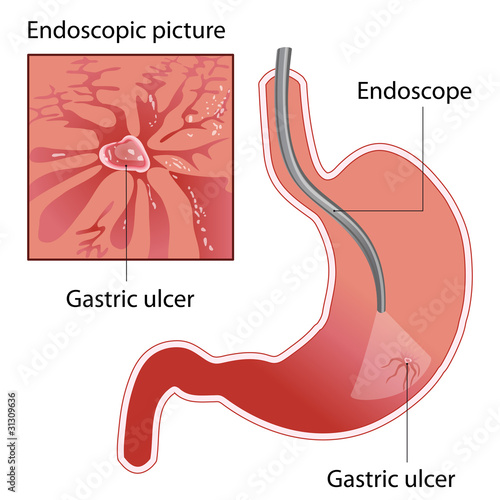 gastric  ulcer photo