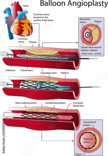 Balloon Angioplasty