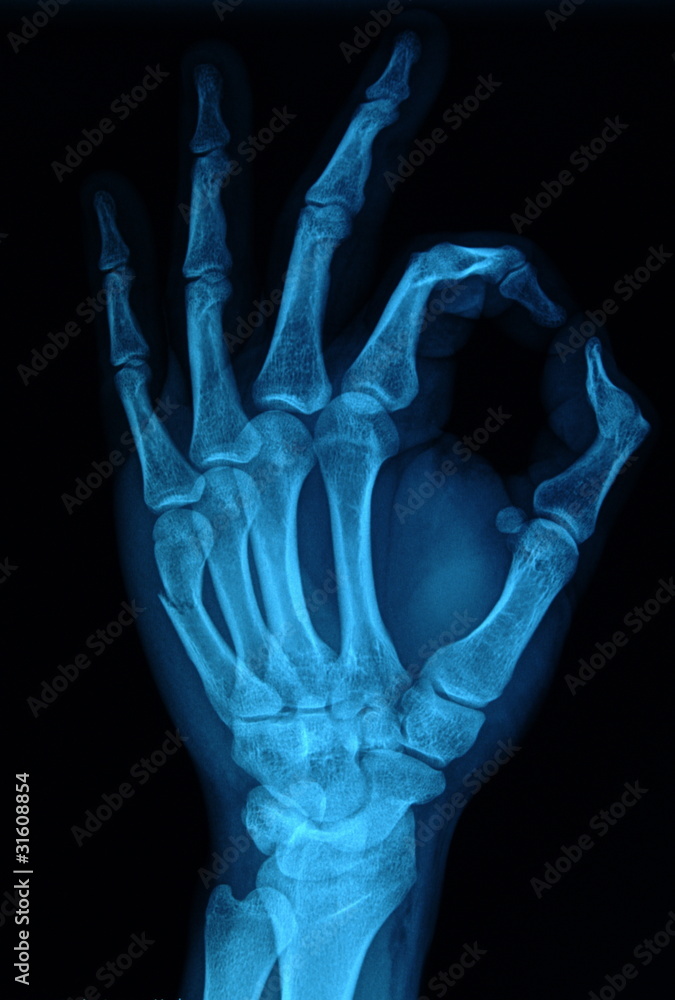 rentgen dłoń - obrazy, fototapety, plakaty 