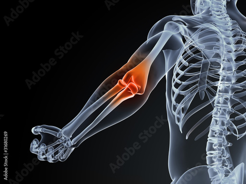 Photography 3d rendered medical illustration of an elbow bursitis
