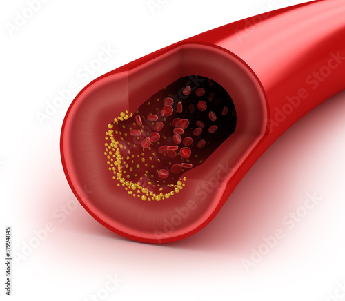 Canvas Print Cholesterol plaque in artery, concept isolated on white